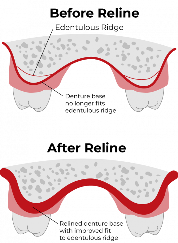 Repair and Reline Dentures in Penticton