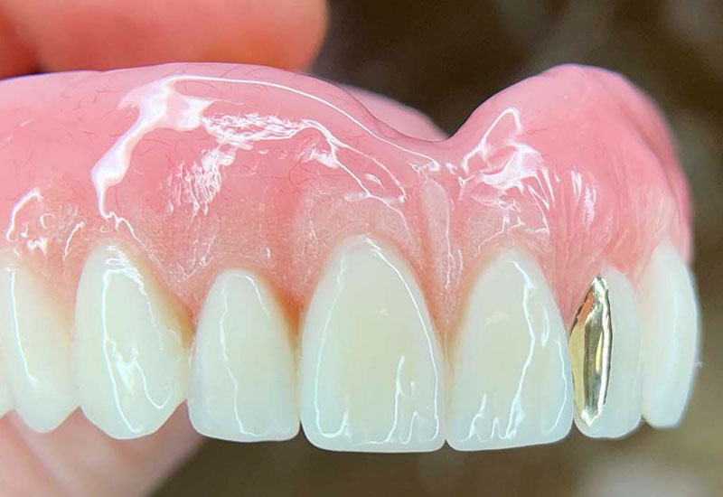 A brand new full upper denture showing customized application of gold