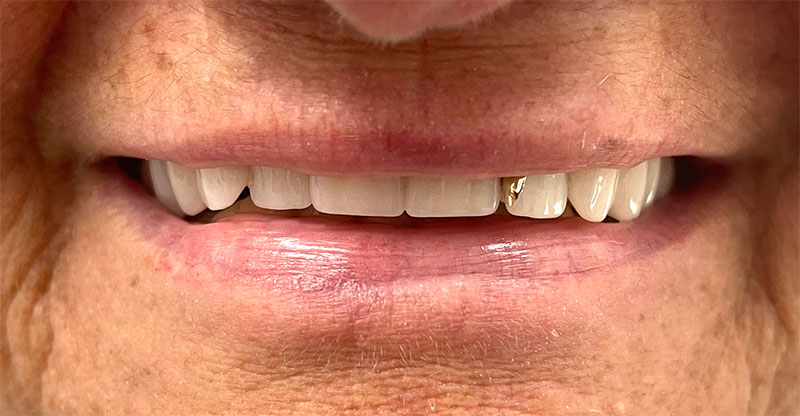 A photo of an upper denture in a person's smiling mouth showing off a gold inlay