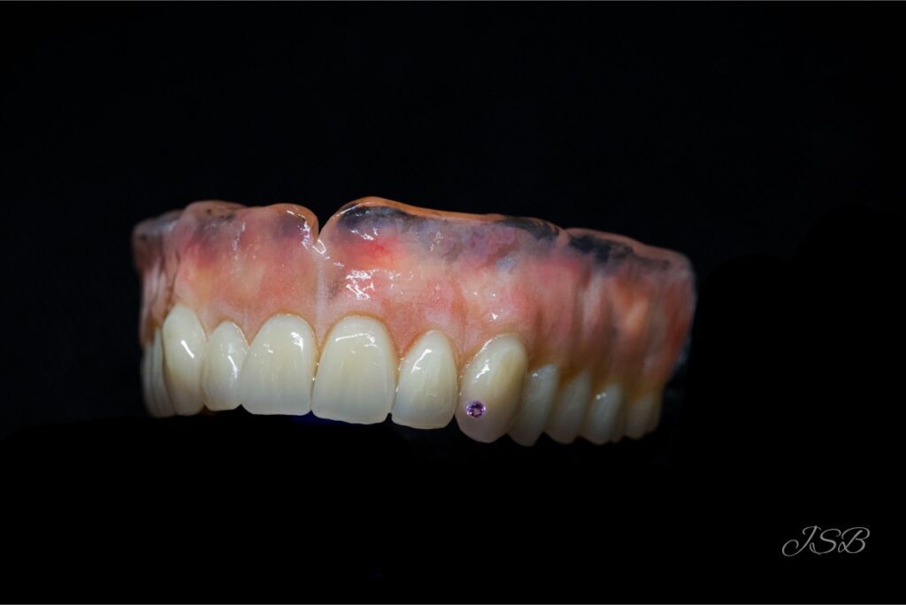 Full upper dentures with stud